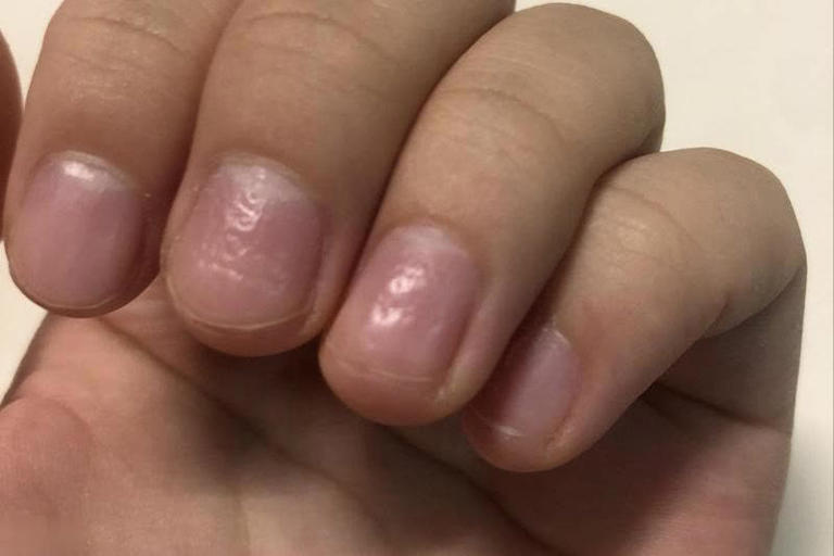 提醒：肾衰竭早期不是腰疼，而是身上4大异常要注意