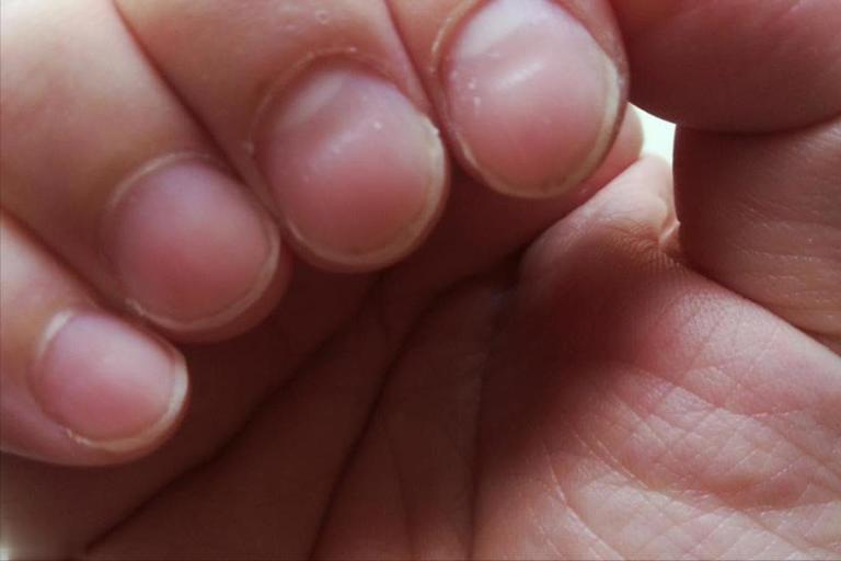 提醒：肾衰竭早期不是腰疼，而是身上4大异常要注意