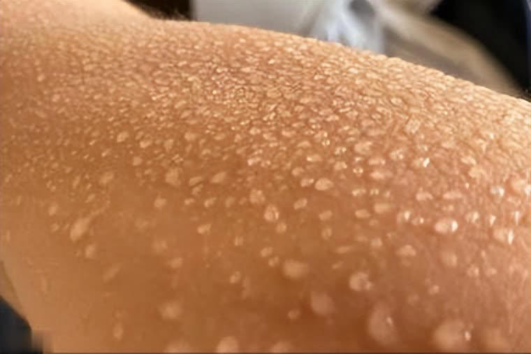 提醒：肾衰竭早期不是腰疼，而是身上4大异常要注意