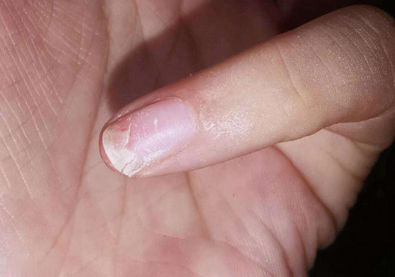 提醒：肾衰竭早期不是腰疼，而是身上4大异常要注意