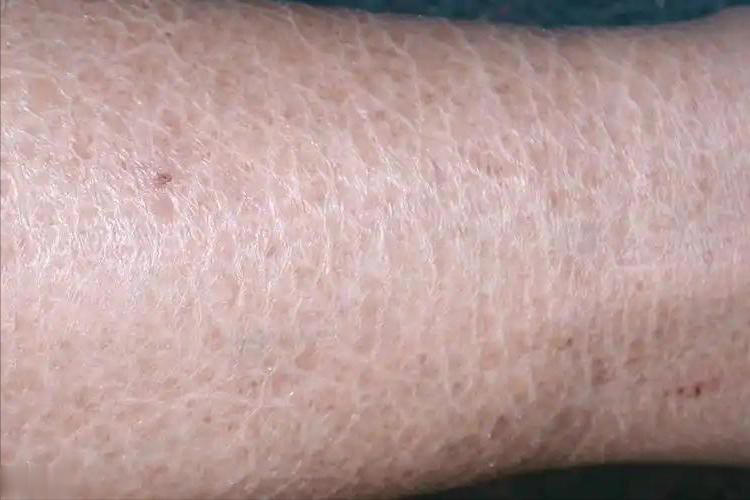 提醒：肾衰竭早期不是腰疼，而是身上4大异常要注意