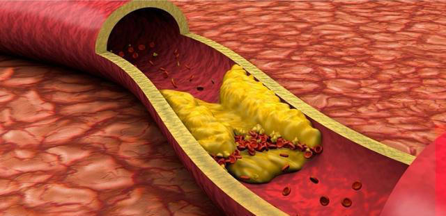 红薯是胆固醇的杀手？医生提醒：胆固醇高的人，3样素菜最好少吃