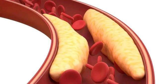红薯是胆固醇的杀手？医生提醒：胆固醇高的人，3样素菜最好少吃