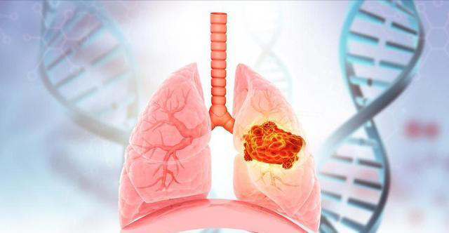 医生忠告：肺癌早期不是咳嗽，而是频繁出现这5症状，千万别忽视