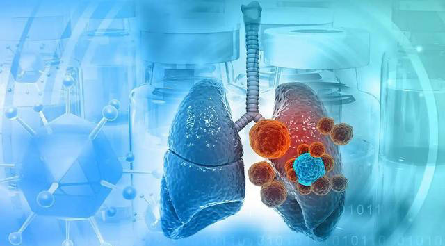 医生忠告：肺癌早期不是咳嗽，而是频繁出现这5症状，千万别忽视