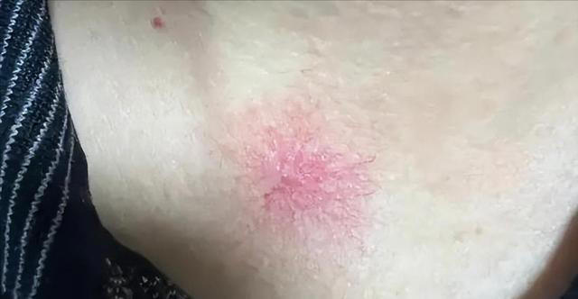 医生告诫：肝癌早期不是腹痛，而是频繁出现这5症状，千万别忽视