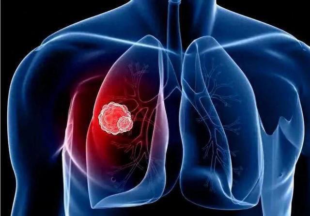 肺部开始癌变，不是看咳不咳，警惕！若发现3个异常或已患癌