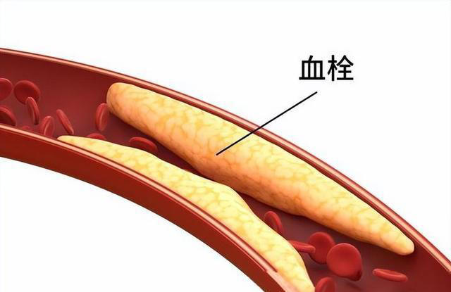 长期久坐不运动的人，若出现这2表现，说明血栓已离你不远了