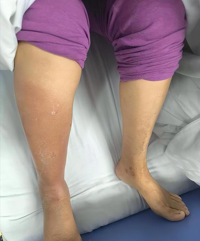 长期久坐不运动的人，若出现这2表现，说明血栓已离你不远了