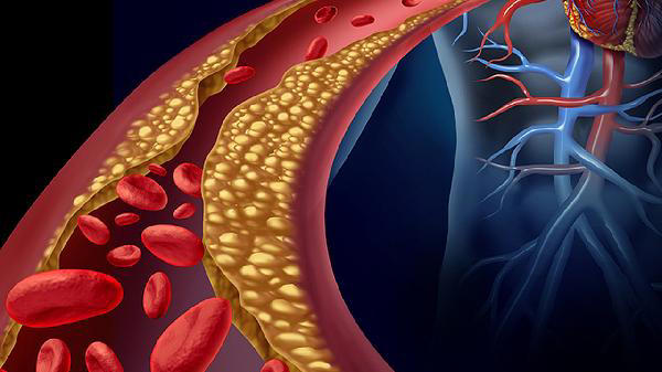  血栓“大户”被揪出，是肥肉的 18 倍：经常吃，血管或扛不住 