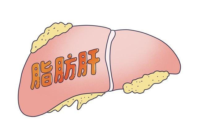 脂肪肝一个鸡蛋都不能吃？建议：不想肝硬化，这4种食物尽量少吃