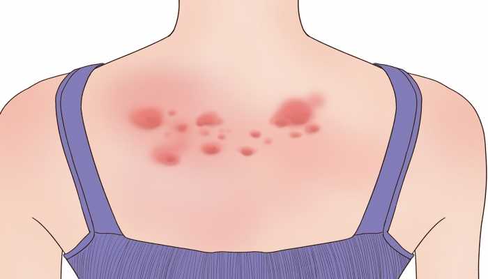 身上起红疙瘩越挠越痒怎么回事