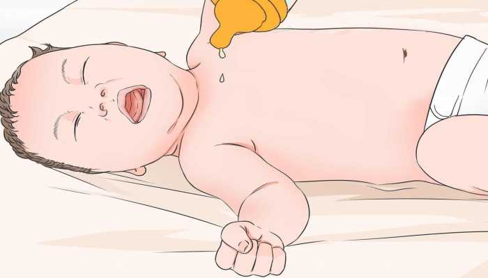 宝宝湿疹和痱子的区别有几种 教你从三方面区分湿疹和痱子