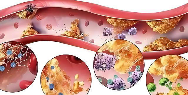 再次提醒：这四种食物容易堵塞血管，中老年人再爱吃也要管住嘴