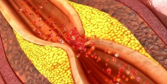 再次提醒：这四种食物容易堵塞血管，中老年人再爱吃也要管住嘴