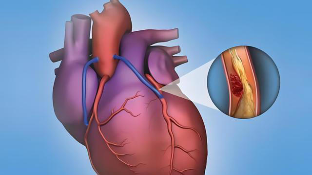 再次提醒：这四种食物容易堵塞血管，中老年人再爱吃也要管住嘴