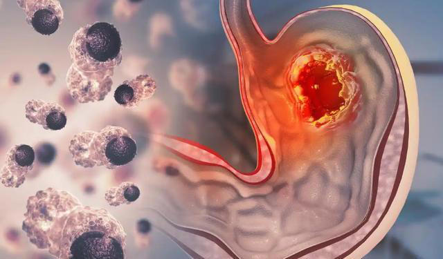 你以为的上火，可能是癌症信号，出现这4种症状，该做检查了