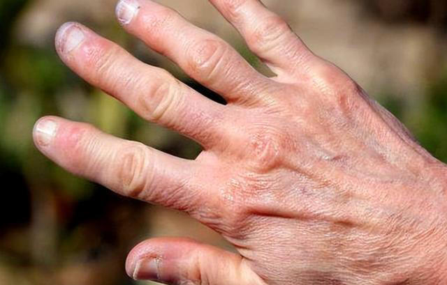 体内有癌，手指先知？注意：手指出现这些症状，要注意疾病信号