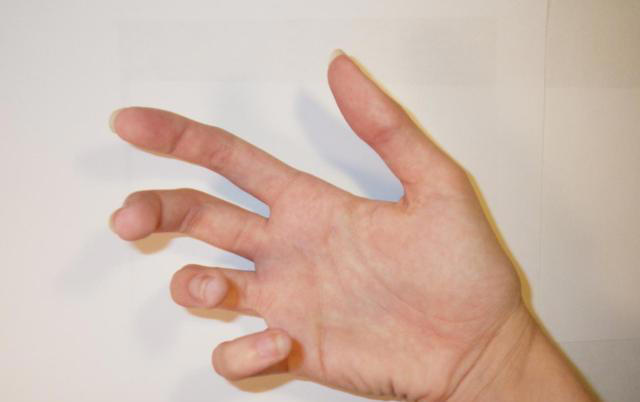 体内有癌，手指先知？注意：手指出现这些症状，要注意疾病信号