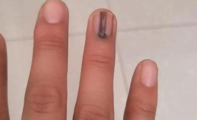 体内有癌，手指先知？注意：手指出现这些症状，要注意疾病信号