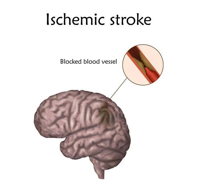 脑梗后还能活多久？医生坦言：关键看这4点，很多人仍有长寿机会