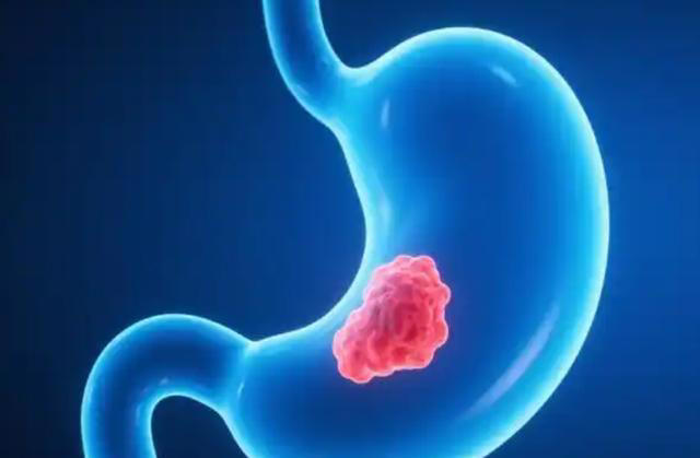 医生劝告：胃癌早期不是反胃，而是频繁出现这3症状，别不当回事