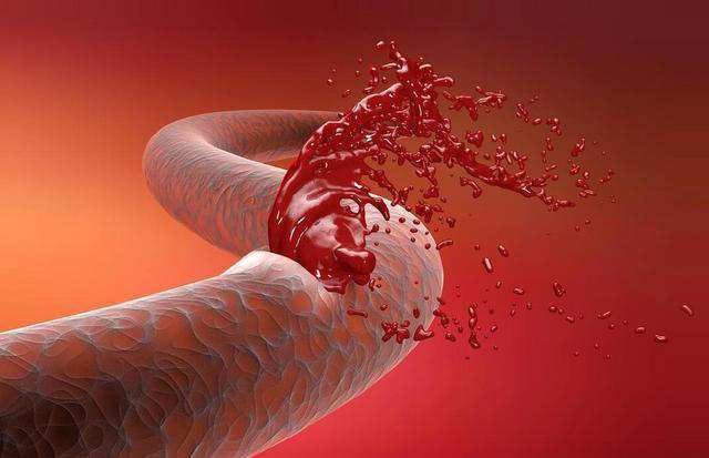 高血压最终都会走向脑出血？提醒：没有这些症状，脑血管还算健康