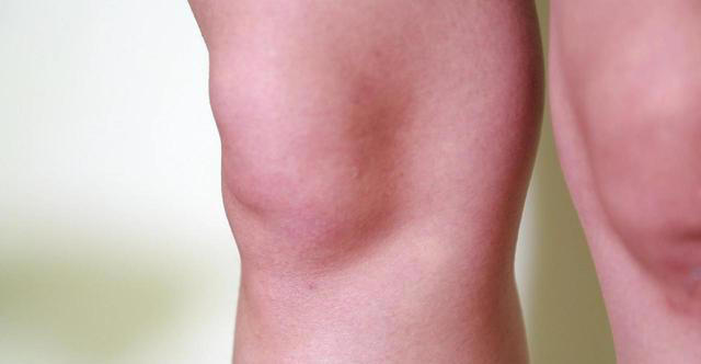 双腿出现这4个症状，肺癌可能已经来了！医生：别只当腿疼！