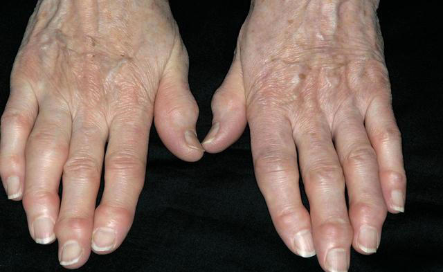 双腿出现这4个症状，肺癌可能已经来了！医生：别只当腿疼！