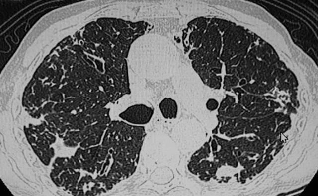 医生再次强调：肺部有结节的人，身上基本有这4个表现，千万注意