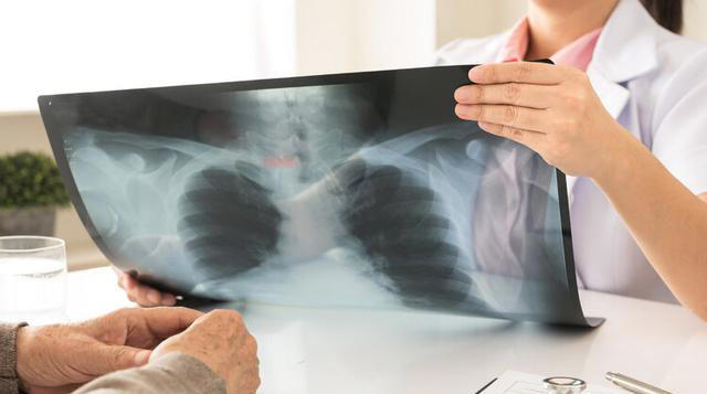 医生再次强调：肺部有结节的人，身上基本有这4个表现，千万注意