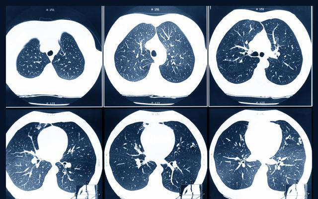 医生再次强调：肺部有结节的人，身上基本有这4个表现，千万注意