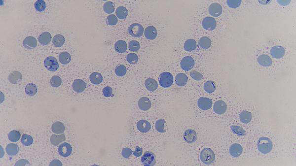 中老年人出现这4大症状，可能是癌症的征兆，提醒：该去检查了