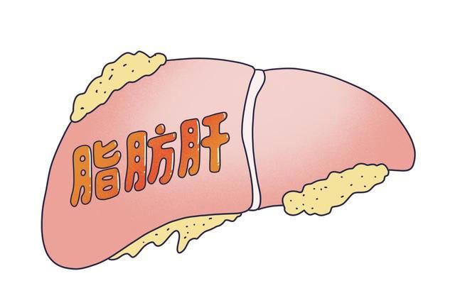 脂肪肝一个鸡蛋都不能吃? 建议：不想肝硬化，4种食物尽量少吃