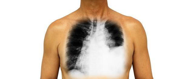 肺癌一查就是晚期？其实双腿早早给了提示！有4个迹象，需早检查