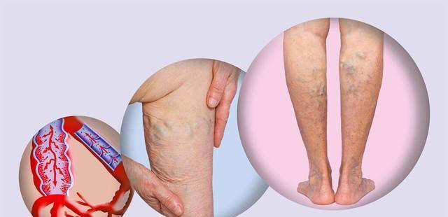 肺癌一查就是晚期？其实双腿早早给了提示！有4个迹象，需早检查