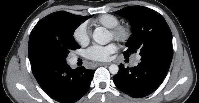医生：希望你的肺部CT报告里，永远别出现这3点描述，别小瞧
