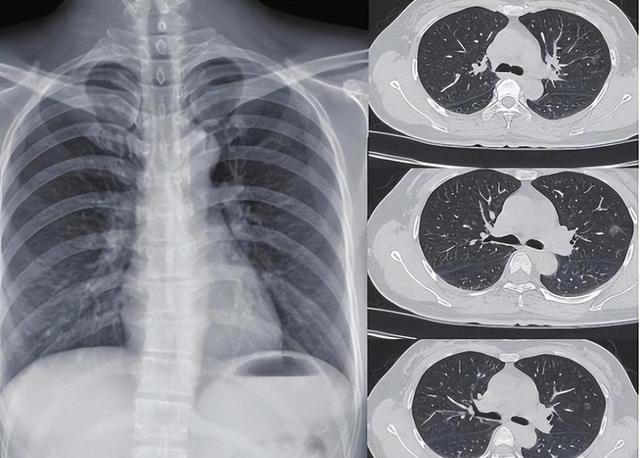 医生：希望你的肺部CT报告里，永远别出现这3点描述，别小瞧