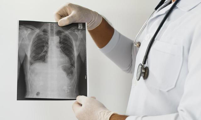 医生：希望你的肺部CT报告里，永远别出现这3点描述，别小瞧