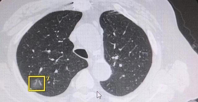 医生：希望你的肺部CT报告里，永远别出现这3点描述，别小瞧