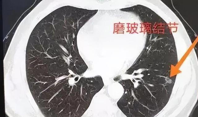 医生：希望你的肺部CT报告里，永远别出现这3点描述，别小瞧