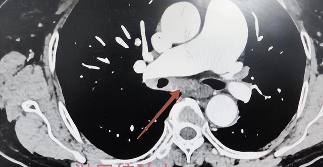 医生：希望你的肺部CT报告里，永远别出现这3点描述，别小瞧