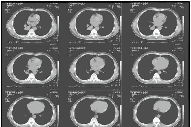 医生：希望你的肺部CT报告里，永远别出现这3点描述，别小瞧