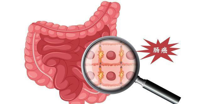 身体有3种异常症状？也许是肠癌来“敲门”，医生提醒：及时就医