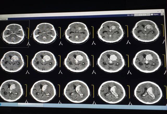血压达到多少会脑出血? 医生：高血压有3条红线，趁早了解!