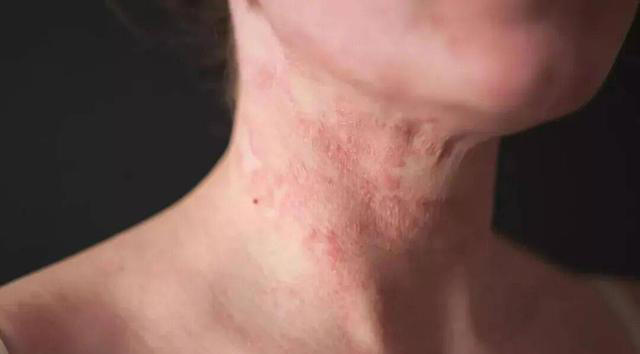 高血压到最后，都是怎么死的？医生叹气：多数是因为这5个并发症