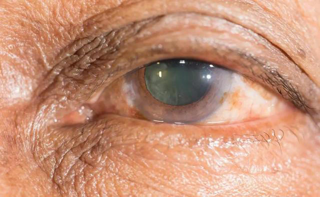 高血压到最后，都是怎么死的？医生叹气：多数是因为这5个并发症