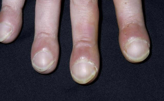 肺部开始病变，不是看咳不咳嗽！提醒：若出现6个异常或已经病变