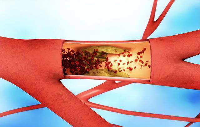 经常吃花生，对血管是好是坏？医生坦言：5种食物尽量少吃