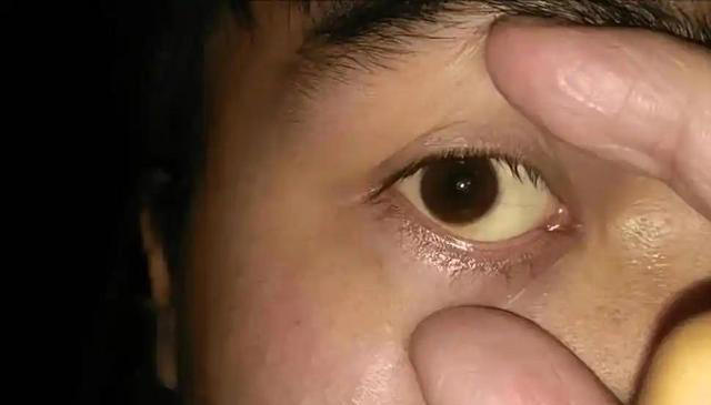 学医后才知道，肝病最危险信号，不是疲劳，而是频繁出现5个症状